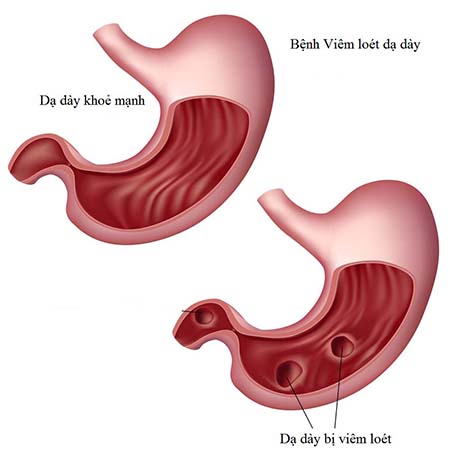 VIÊN DẠ TRÀNG-TW3 (Viêm Loét Dạ Dày-30v)